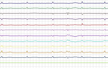 Electrocardiogram for St. Petersburg Institute of Cardiological Technics 12-lead Arrhythmia, record I02