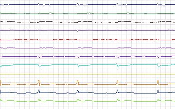 Electrocardiogram for St. Petersburg Institute of Cardiological Technics 12-lead Arrhythmia, record I03