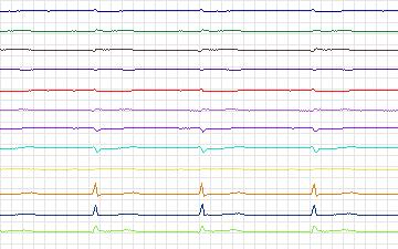 Electrocardiogram for St. Petersburg Institute of Cardiological Technics 12-lead Arrhythmia, record I04