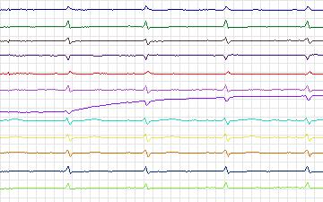 Electrocardiogram for St. Petersburg Institute of Cardiological Technics 12-lead Arrhythmia, record I06
