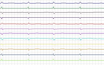 Electrocardiogram for St. Petersburg Institute of Cardiological Technics 12-lead Arrhythmia, record I07