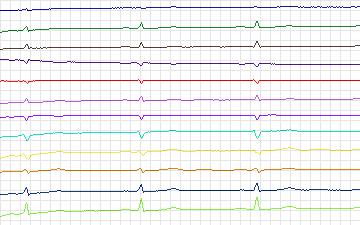 Electrocardiogram for St. Petersburg Institute of Cardiological Technics 12-lead Arrhythmia, record I08