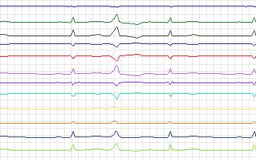 Electrocardiogram for St. Petersburg Institute of Cardiological Technics 12-lead Arrhythmia, record I13