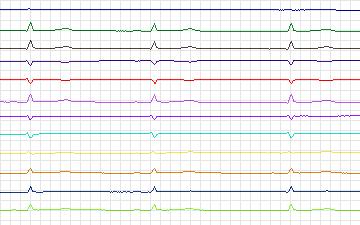 Electrocardiogram for St. Petersburg Institute of Cardiological Technics 12-lead Arrhythmia, record I14