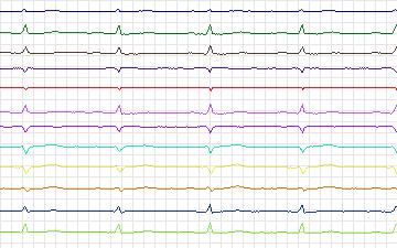 Electrocardiogram for St. Petersburg Institute of Cardiological Technics 12-lead Arrhythmia, record I15
