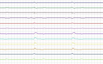 Electrocardiogram for St. Petersburg Institute of Cardiological Technics 12-lead Arrhythmia, record I17