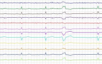 Electrocardiogram for St. Petersburg Institute of Cardiological Technics 12-lead Arrhythmia, record I18