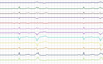 Electrocardiogram for St. Petersburg Institute of Cardiological Technics 12-lead Arrhythmia, record I19