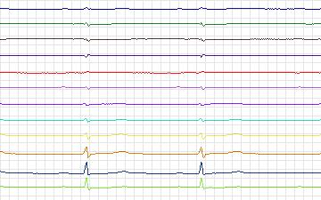 Electrocardiogram for St. Petersburg Institute of Cardiological Technics 12-lead Arrhythmia, record I41