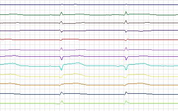 Electrocardiogram for St. Petersburg Institute of Cardiological Technics 12-lead Arrhythmia, record I62
