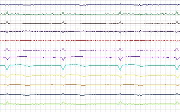 Electrocardiogram for St. Petersburg Institute of Cardiological Technics 12-lead Arrhythmia, record I64
