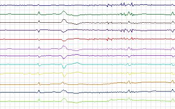 Electrocardiogram for St. Petersburg Institute of Cardiological Technics 12-lead Arrhythmia, record I65