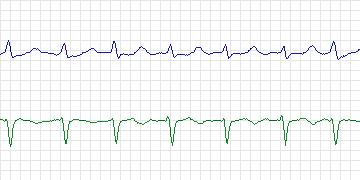 Electrocardiogram for Long-Term AF, record 111