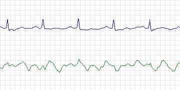 Electrocardiogram for Long-Term AF, record 113