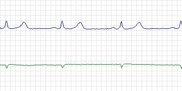 Electrocardiogram for Long-Term AF, record 114