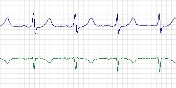Electrocardiogram for Long-Term AF, record 115
