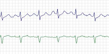 Electrocardiogram for Long-Term AF, record 16