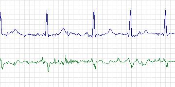 Electrocardiogram for Long-Term AF, record 21
