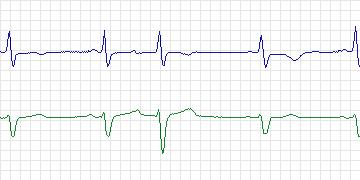 Electrocardiogram for Long-Term AF, record 22