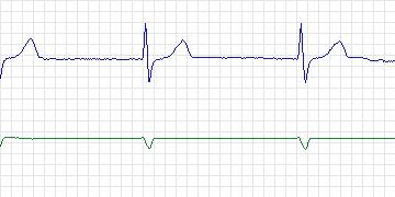 Electrocardiogram for Long-Term AF, record 23