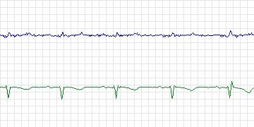 Electrocardiogram for Long-Term AF, record 24