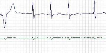 Electrocardiogram for Long-Term AF, record 25