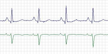 Electrocardiogram for Long-Term AF, record 28