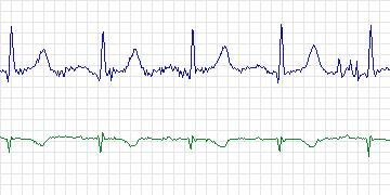 Electrocardiogram for Long-Term AF, record 30