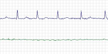 Electrocardiogram for Long-Term AF, record 33