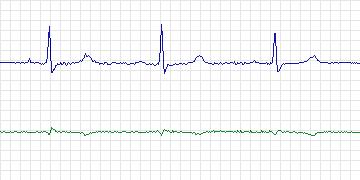 Electrocardiogram for Long-Term AF, record 35