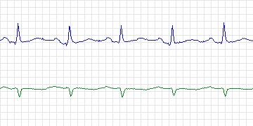 Electrocardiogram for Long-Term AF, record 42