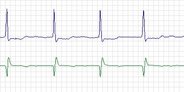 Electrocardiogram for Long-Term AF, record 43
