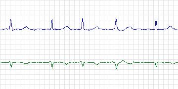 Electrocardiogram for Long-Term AF, record 44