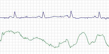 Electrocardiogram for Long-Term AF, record 55