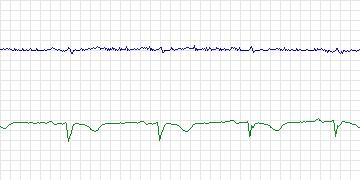 Electrocardiogram for Long-Term AF, record 56