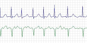 Electrocardiogram for Long-Term AF, record 68