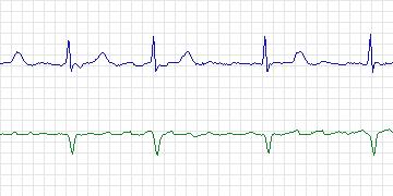 Electrocardiogram for Long-Term AF, record 69