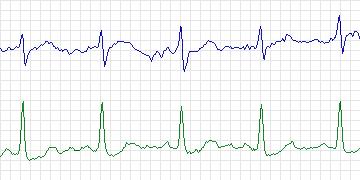 Electrocardiogram for Long-Term ST, record s20181