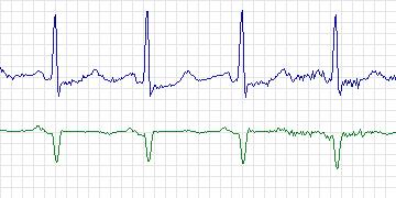 Electrocardiogram for Long-Term ST, record s20201