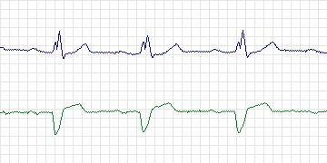 Electrocardiogram for MIT-BIH Arrhythmia, record 111