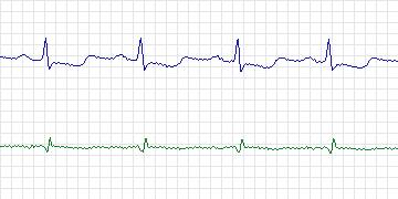 Electrocardiogram for MIT-BIH Arrhythmia, record 112