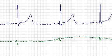 Electrocardiogram for MIT-BIH Arrhythmia, record 113