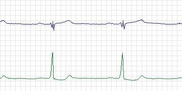 Electrocardiogram for MIT-BIH Arrhythmia, record 114