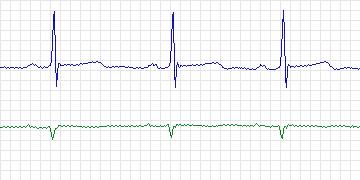 Electrocardiogram for MIT-BIH Arrhythmia, record 115