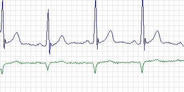 Electrocardiogram for MIT-BIH Arrhythmia, record 116