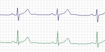Electrocardiogram for MIT-BIH Arrhythmia, record 117