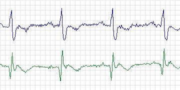 Electrocardiogram for MIT-BIH Arrhythmia, record 118