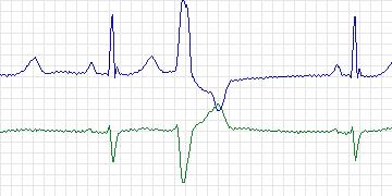 Electrocardiogram for MIT-BIH Arrhythmia, record 119