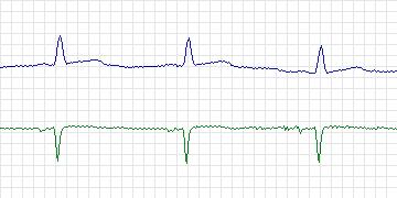 Electrocardiogram for MIT-BIH Arrhythmia, record 121