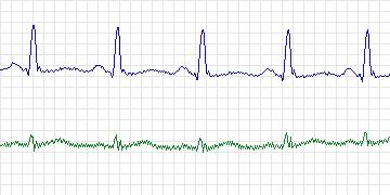 Electrocardiogram for MIT-BIH Arrhythmia, record 122